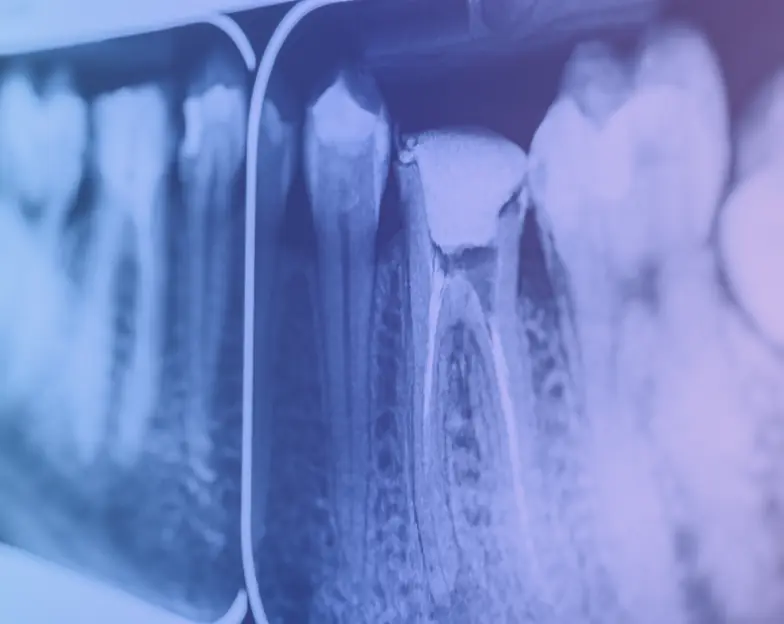 Medical and dental marketing in UAE: Close-up dental radiograph showing tooth roots for Endodontics and Periodontics